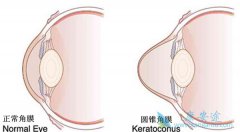 ����ҽ�������������ĳ��ִ���Բ׶��Ĥ��������