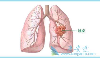 肺癌转移 肺癌转移