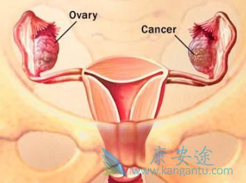 卵巢癌 卵巢癌