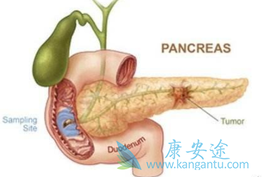 胰脏癌 胰脏癌