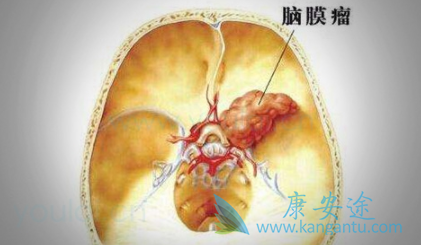 脑膜瘤治疗 脑膜瘤治疗