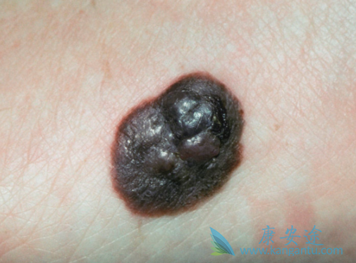 黑色素瘤 黑色素瘤