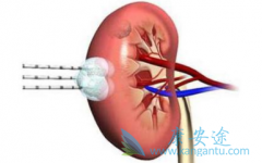 ��άĪ˾(Everolimus)����������������ҩ����