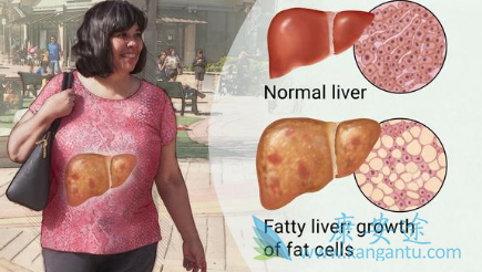 非酒精性脂肪性肝炎 非酒精性脂肪性肝炎