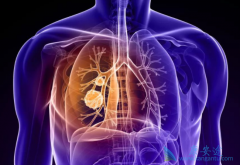 ��������(Brigatinib)����Щ����ȿ����������㣿