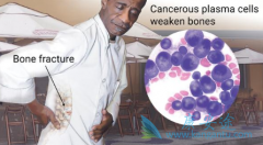 �෢�Թ�����������ҩSelinexor������Ч����ô����