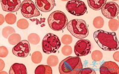 ʲô��Ѫ����CAR-T�Ʒ����κ�Ѫ����