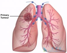 ӵ��METͻ��ͻ��ķ�Сϸ���ΰ�����ʹ������ҩ��Capmatinib��Ч������