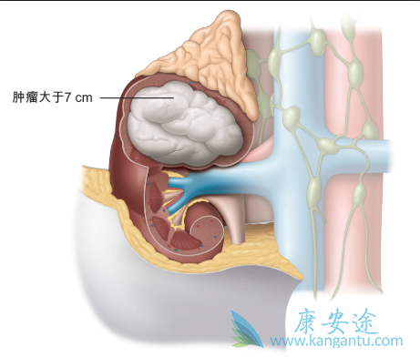 肾细胞癌 肾细胞癌