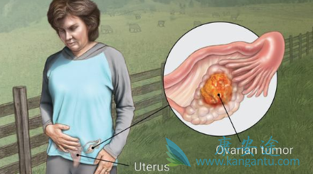 卵巢癌的治疗 卵巢癌的治疗