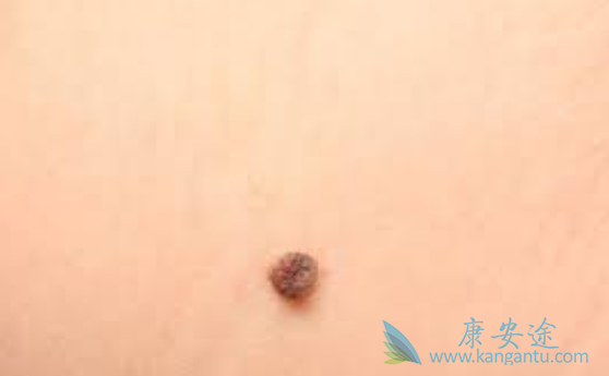 Ƥ����֢������֢״