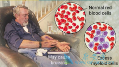 2017-2018����AMLҩ����Crenolanib�����ı�����