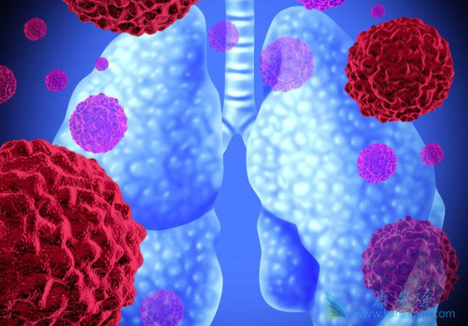 肺癌晚期 肺癌晚期
