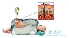 ������ֲ�ǲ������ư�Ѫ������Ч������