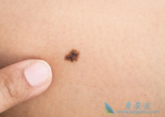 �ٴ��г����ĺ�ɫ��������֢״��ʲô��