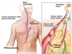 ����������ת�Ƶģ�����ת��֢״����Щ��