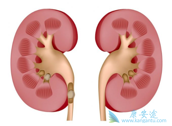肾癌转移 肾癌转移