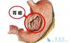 ������ת����θ��������ҩ������Щ��