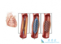 心脏支架手术之后血管还会二次堵塞吗？