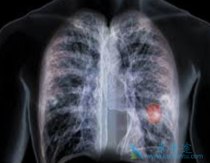 EGFRͻ�����ڷ�Сϸ���ΰ������Ƽ�ʹ��ʲôҩ�����ƣ�