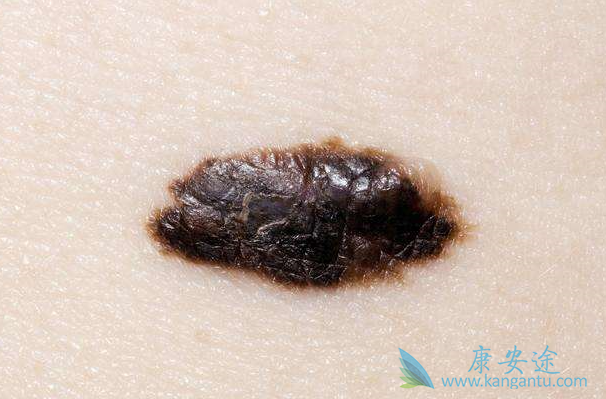 黑色素瘤治疗 黑色素瘤治疗