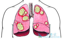 �ӳ������ڷΰ���֢״���ΰ����ڴ����Ҫ��ã�