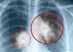 ALK���Է�Сϸ���ΰ�������ҩ���ĸ���