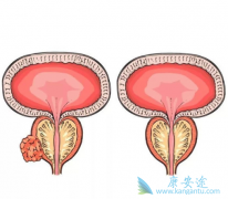 ǰ���ٰ���ҩNubeqa����Ч�Ͱ�ȫ����ô����