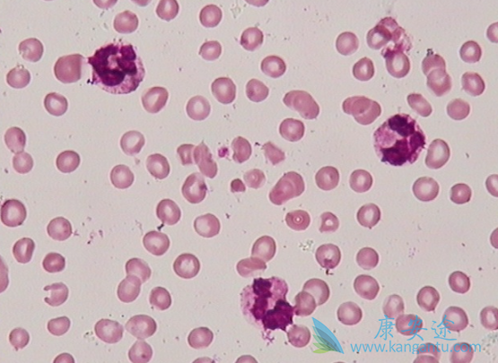 ���������쳣�ۺ�֢