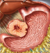 ��ҩripretinib����Ч����θ�����������ļ�����չ����������