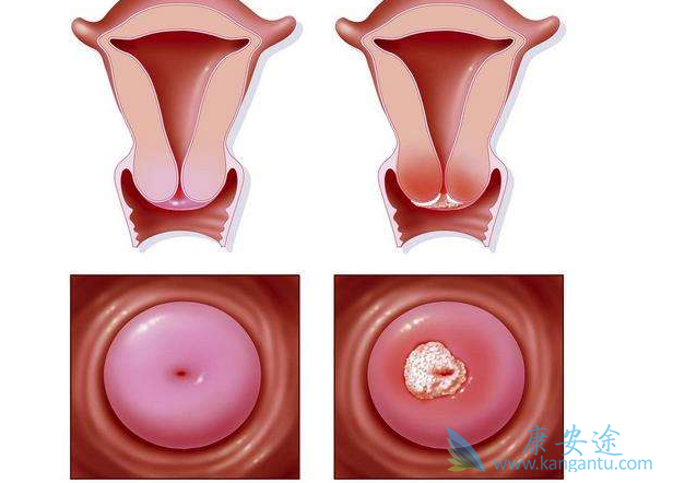 宫颈癌晚期能活多久 宫颈癌晚期能活多久