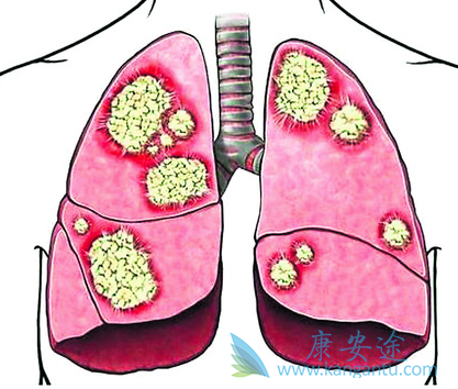 肺癌患者 肺癌患者