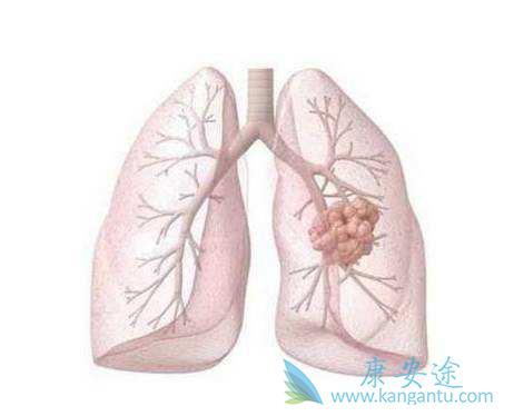 肺癌肝转移 肺癌肝转移