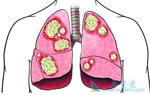 肺癌egfr靶点 肺癌egfr靶点