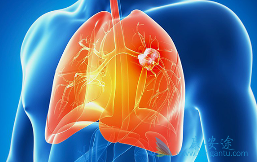 肺癌脑转移 肺癌脑转移