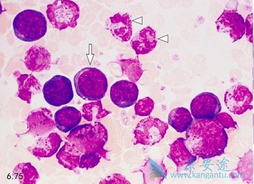 急性骨髓细胞白血病 急性骨髓细胞白血病