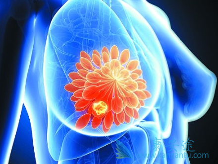 乳腺癌的原因 乳腺癌的原因