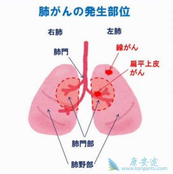 肺癌晚期怎么治疗;肺癌治疗 肺癌晚期怎么治疗;肺癌治疗