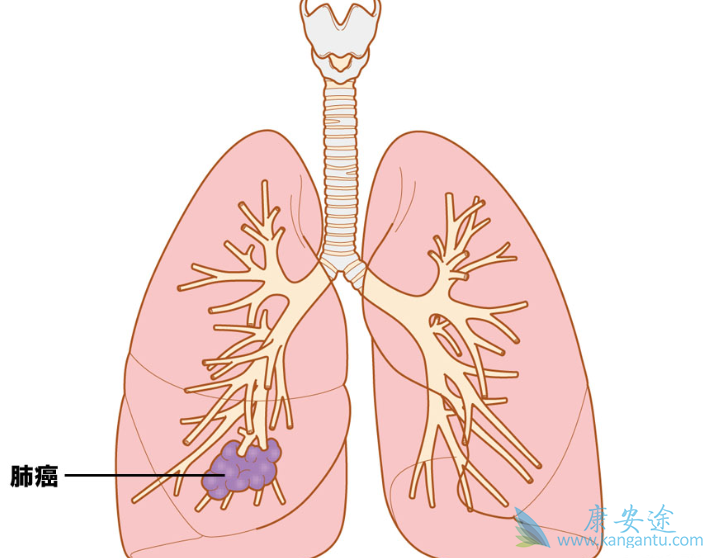 肺癌的治疗;非小细胞肺癌 肺癌的治疗;非小细胞肺癌