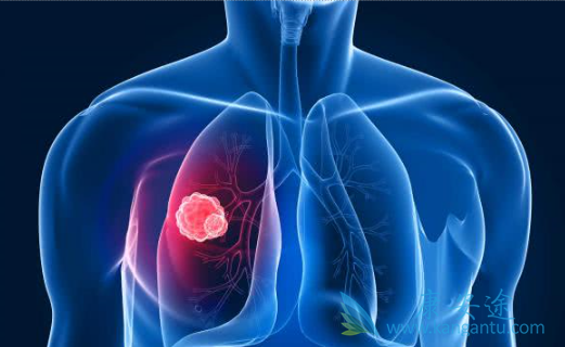 肺鳞癌 肺鳞癌