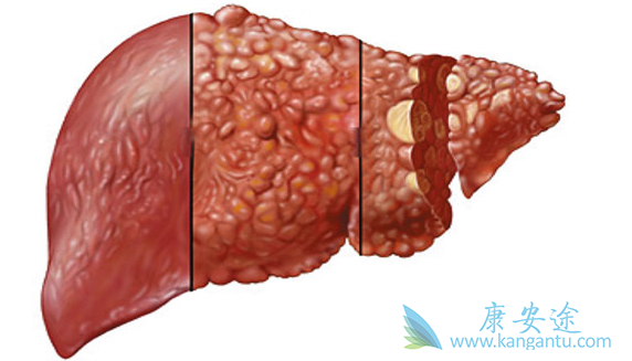 肝癌;肝癌药物 肝癌;肝癌药物