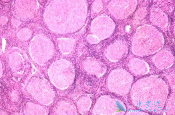 霍奇金淋巴瘤 霍奇金淋巴瘤