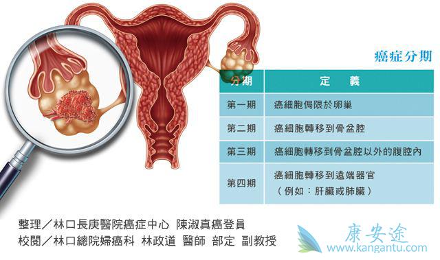卵巢癌 卵巢癌