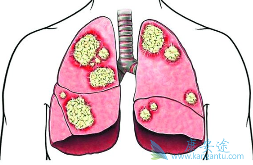 肺癌egfr靶点 肺癌egfr靶点