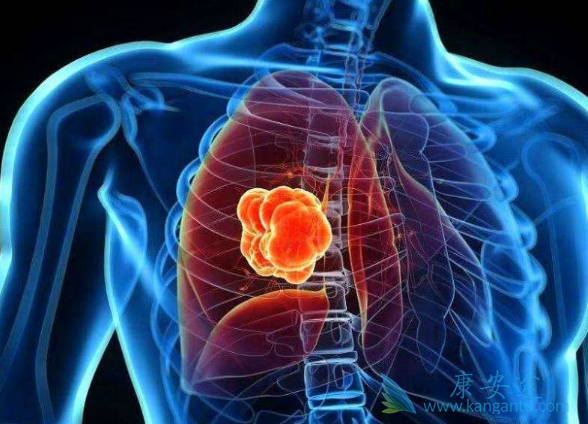 肺癌晚期有治好的吗 肺癌晚期有治好的吗