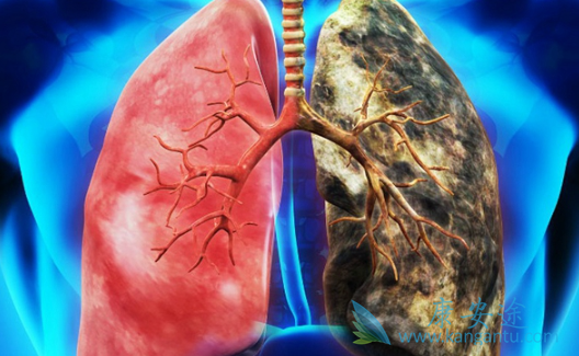 肺鳞癌 肺鳞癌