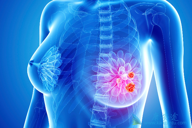 乳腺癌治疗 乳腺癌治疗