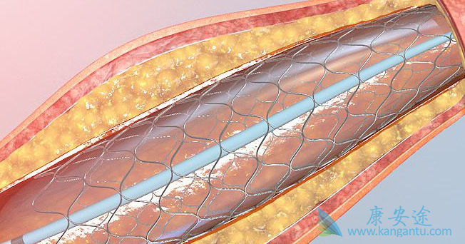 生物可降解支架;心脏支架 生物可降解支架;心脏支架