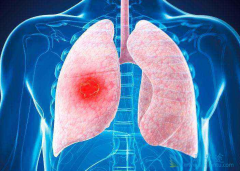 �ΰ�������֢״����Щ֢״������ת�ƺ���ô�죿