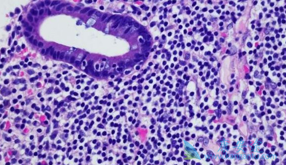 肿瘤;黑色素瘤 肿瘤;黑色素瘤